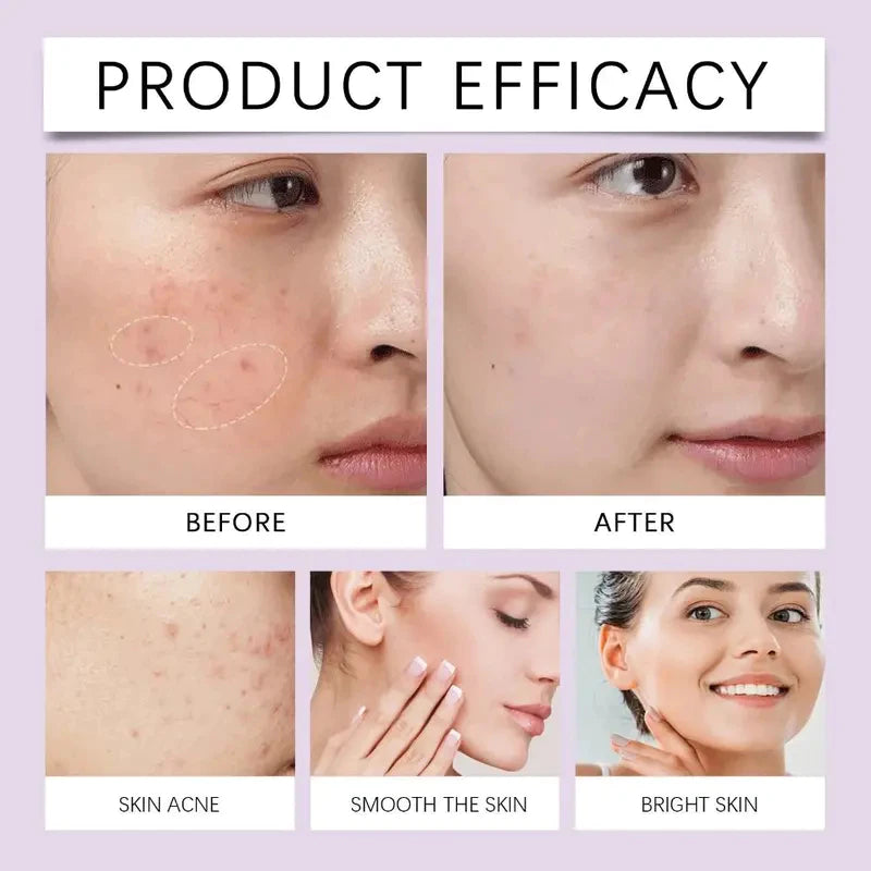 12% Azelaic Acid Acne Cream Acne Redness Relief 20g