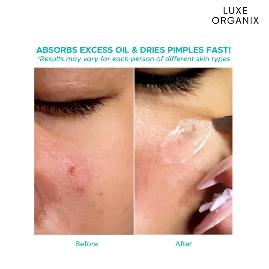 LUXE ORGANIX Hydrocolloid Acne Spot Patch Night (48 Patches)